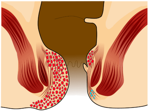 Blood in stool or tar stools: causes and treatment